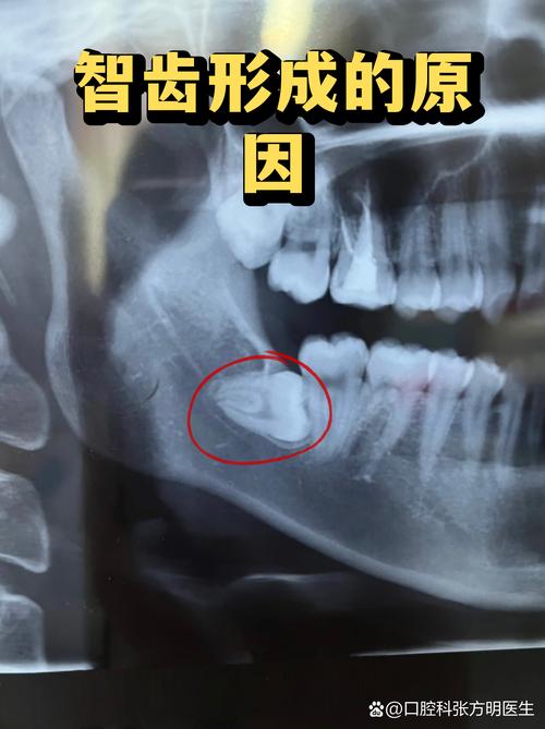 由于现代人颌骨空间不足,很多智齿无法正常生长,导致各种口腔问题